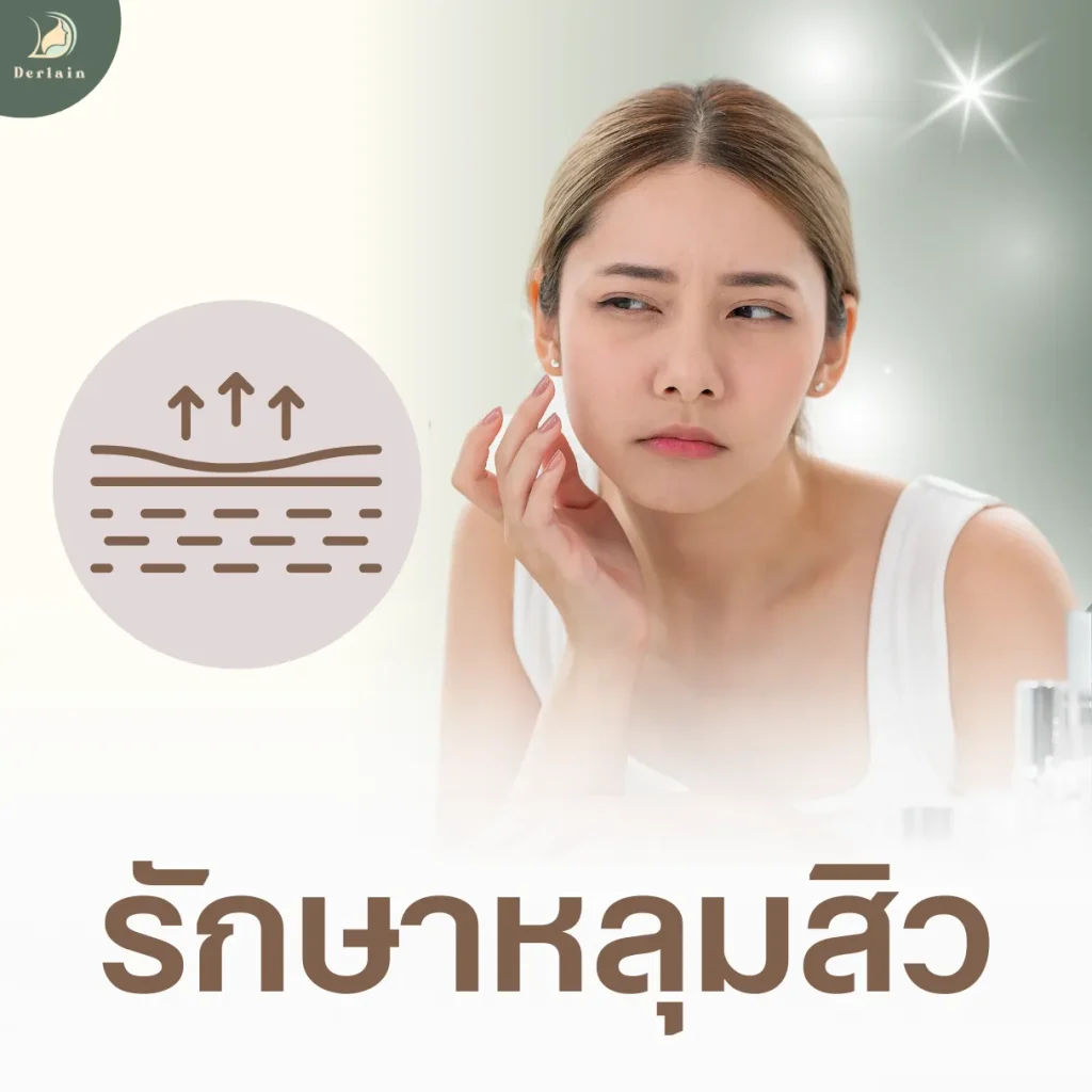 บริการของเดอร์เลนคลินิก - รักษาหลุมสิว
