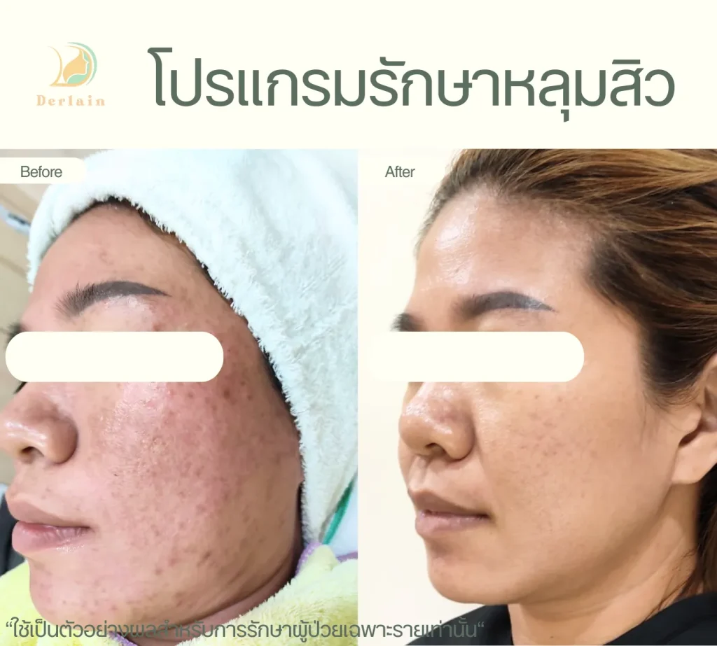 รีวิวรักษาหลุมสิว 1 - เดอร์เลนคลินิก
