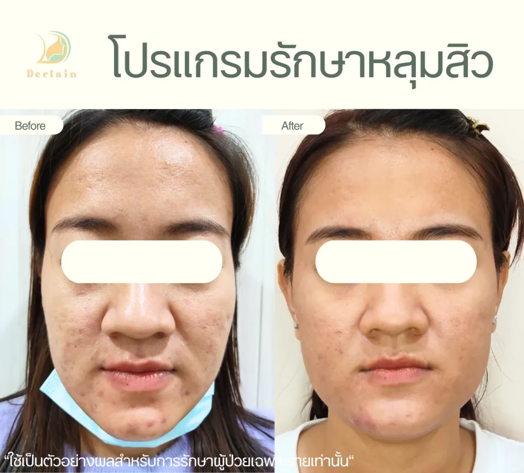 รีวิวรักษาหลุมสิว 10 - เดอร์เลนคลินิก