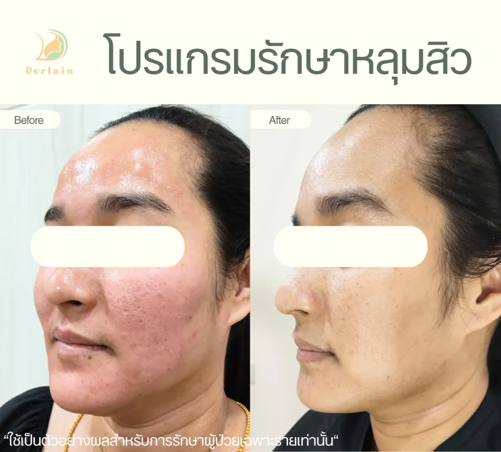 รีวิวรักษาหลุมสิว 11 - เดอร์เลนคลินิก