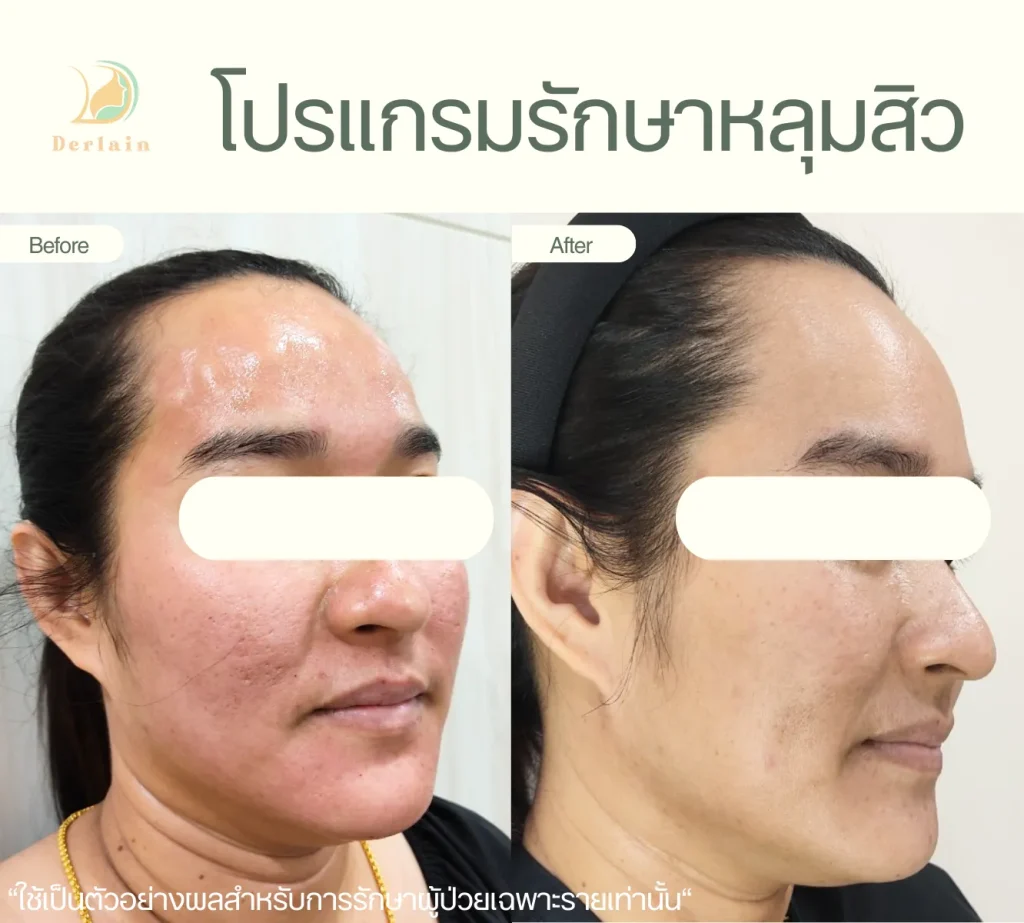 รีวิวรักษาหลุมสิว 12 - เดอร์เลนคลินิก