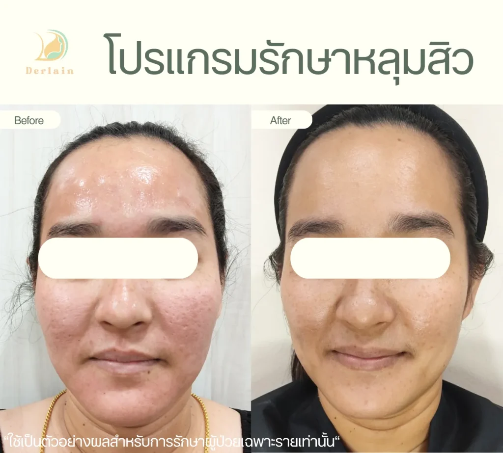 รีวิวรักษาหลุมสิว 13 - เดอร์เลนคลินิก