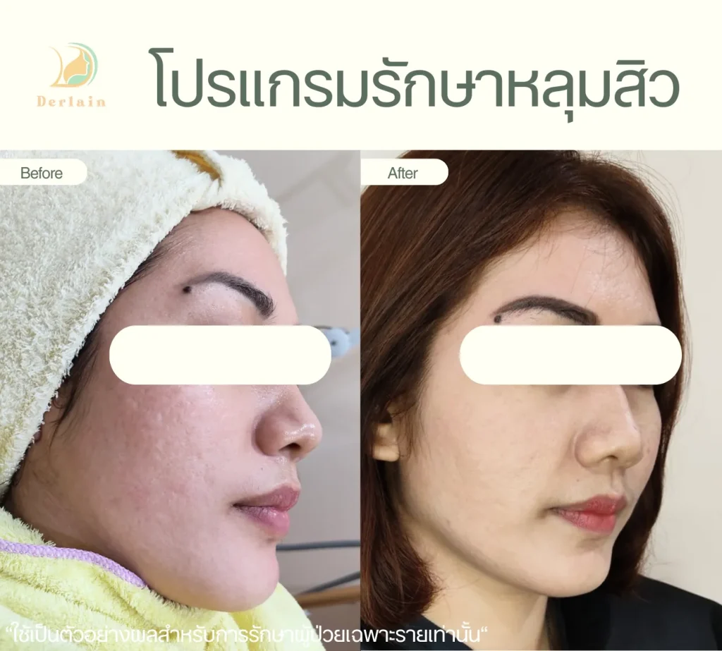 รีวิวรักษาหลุมสิว 14 - เดอร์เลนคลินิก