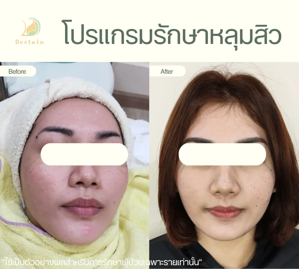 รีวิวรักษาหลุมสิว 15 - เดอร์เลนคลินิก