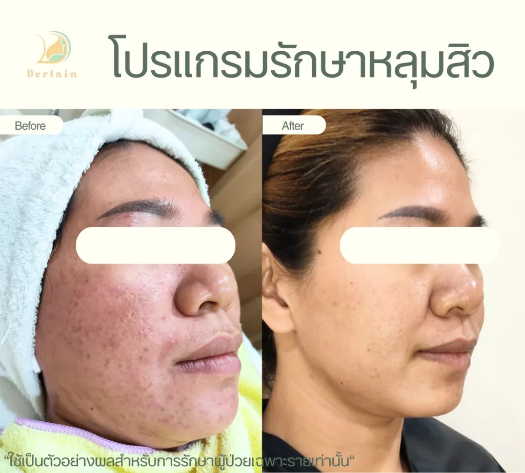 รีวิวรักษาหลุมสิว 2 - เดอร์เลนคลินิก