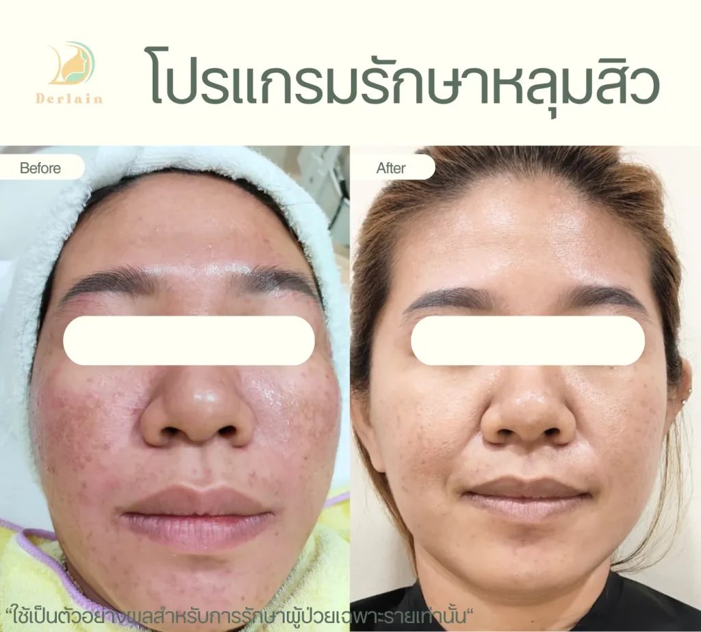 รีวิวรักษาหลุมสิว 3 - เดอร์เลนคลินิก