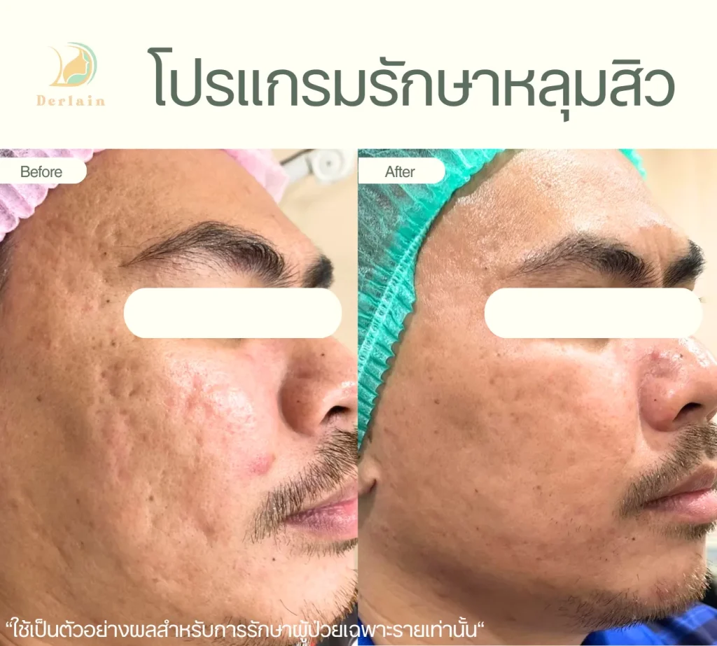 รีวิวรักษาหลุมสิว 4 - เดอร์เลนคลินิก