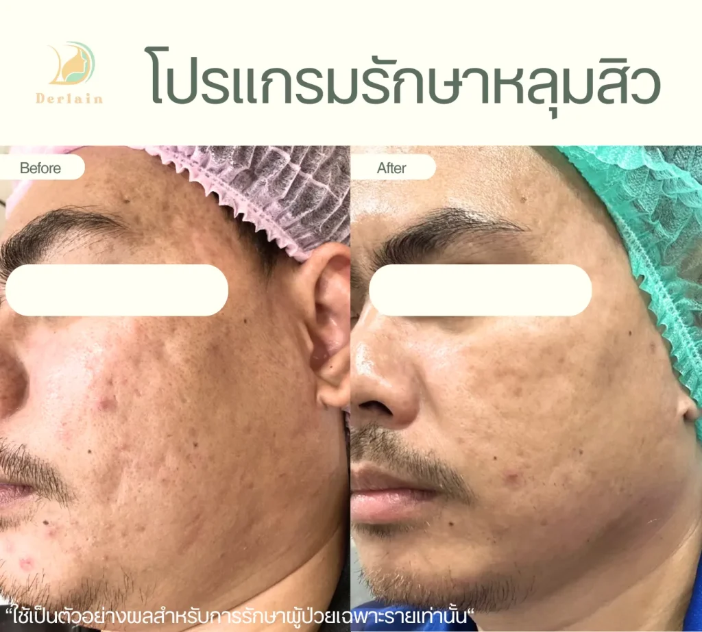 รีวิวรักษาหลุมสิว 5 - เดอร์เลนคลินิก