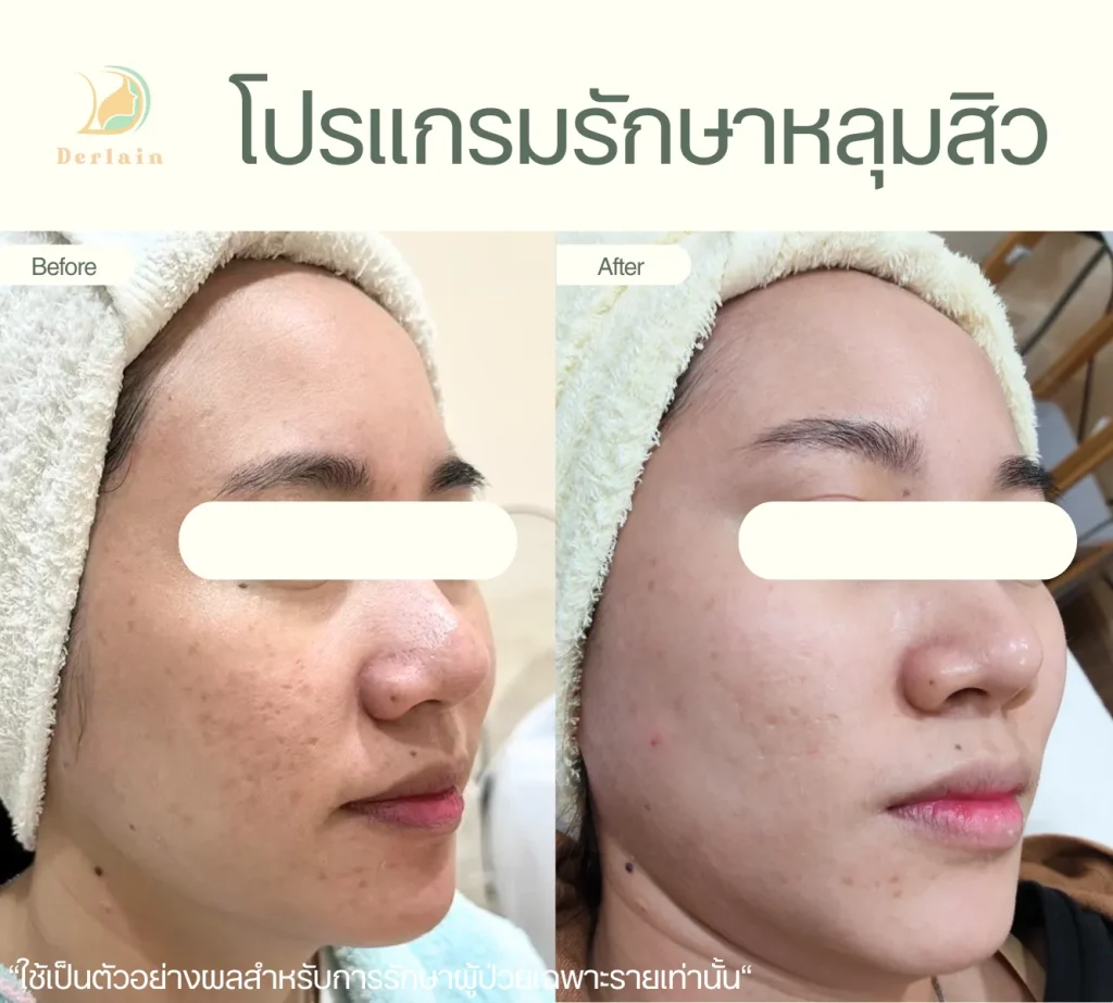 รีวิวรักษาหลุมสิว 6 - เดอร์เลนคลินิก