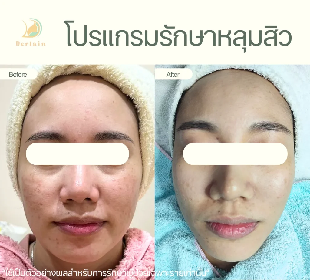 รีวิวรักษาหลุมสิว 7 - เดอร์เลนคลินิก