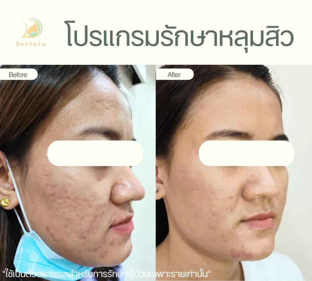 รีวิวรักษาหลุมสิว 8 - เดอร์เลนคลินิก