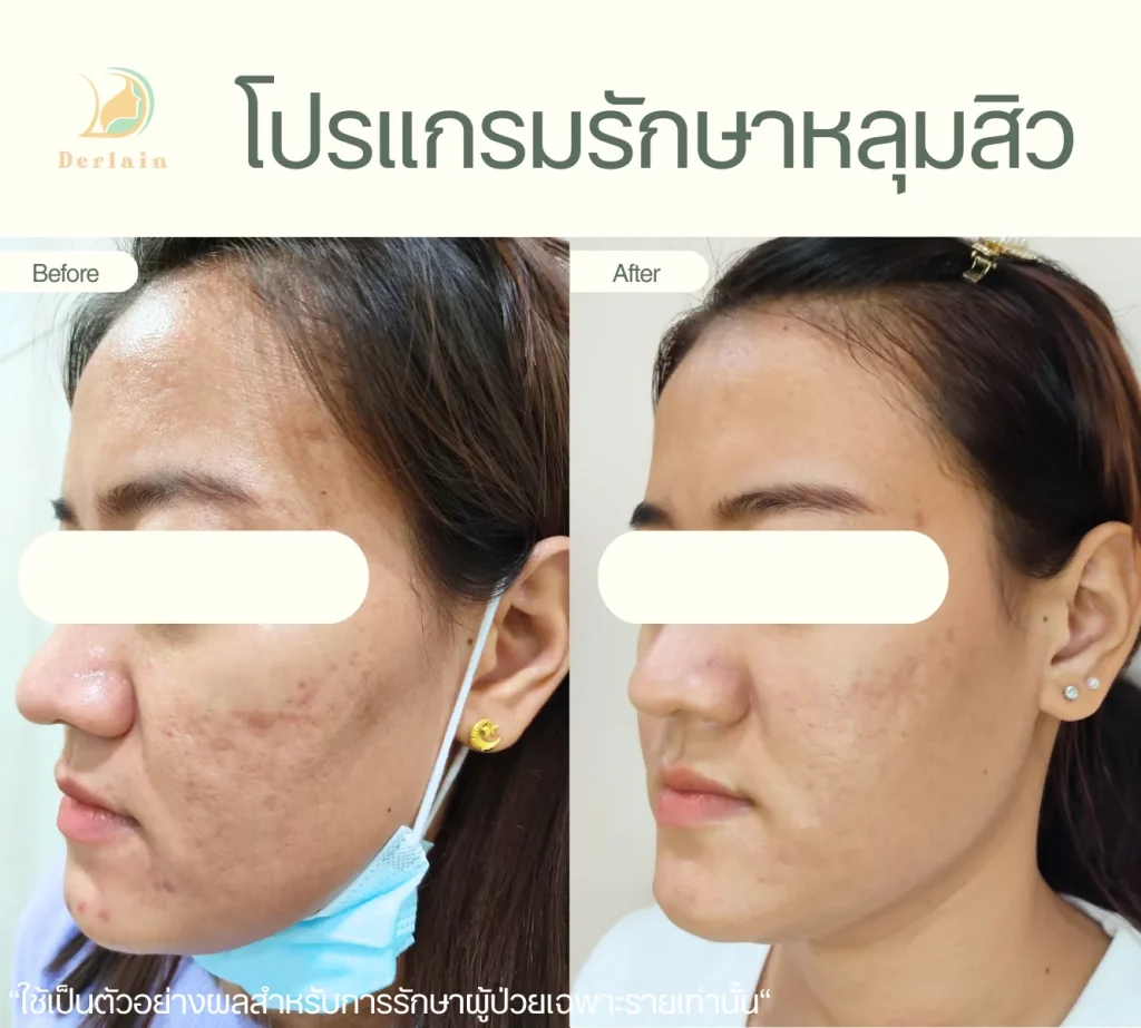 รีวิวรักษาหลุมสิว 9 - เดอร์เลนคลินิก
