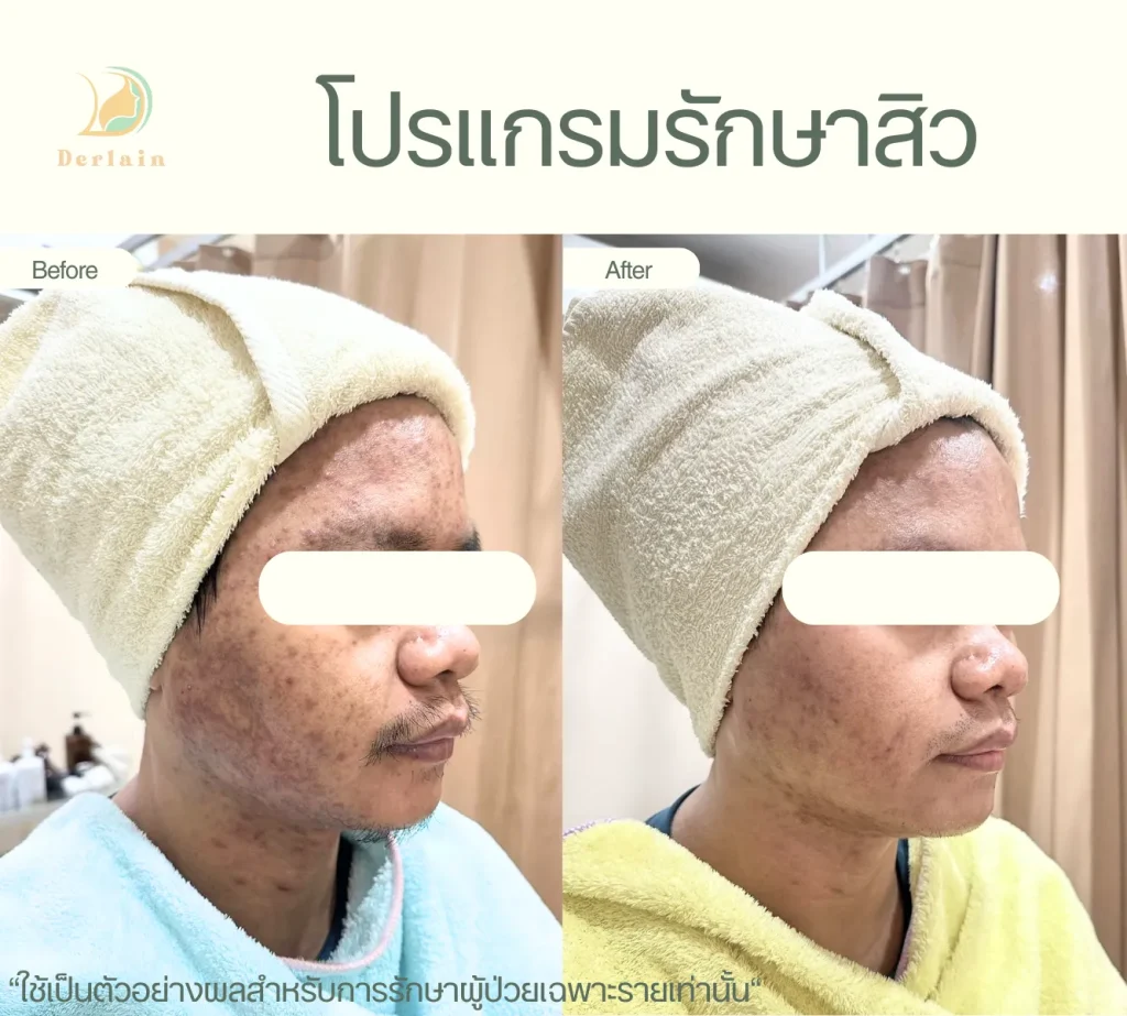 รีวิวโปรแกรมรักษาสิว 30 - เดอร์เลนคลินิก