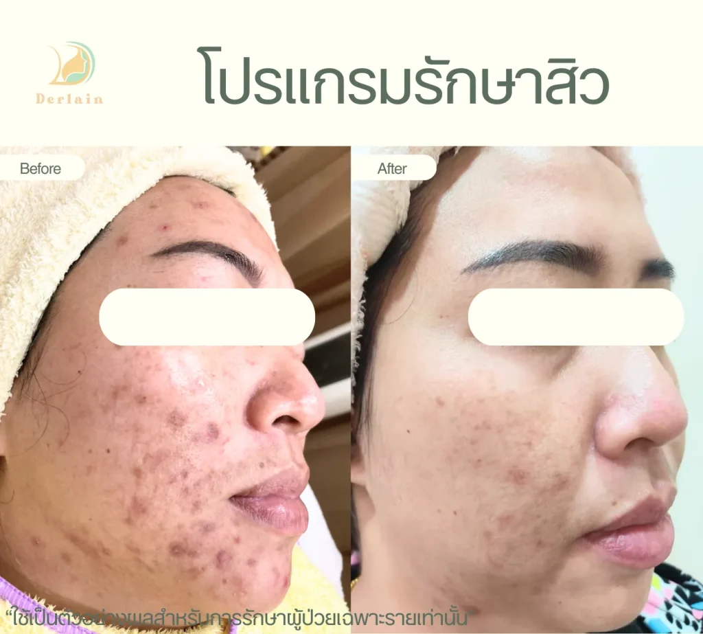 รีวิวโปรแกรมรักษาสิว 21 - เดอร์เลนคลินิก