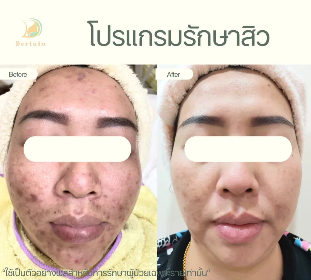 รีวิวโปรแกรมรักษาสิว 20 - เดอร์เลนคลินิก