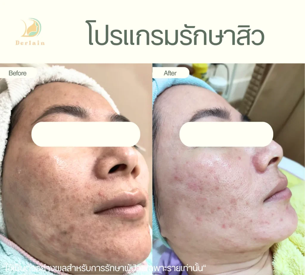 รีวิวโปรแกรมรักษาสิว 19 - เดอร์เลนคลินิก