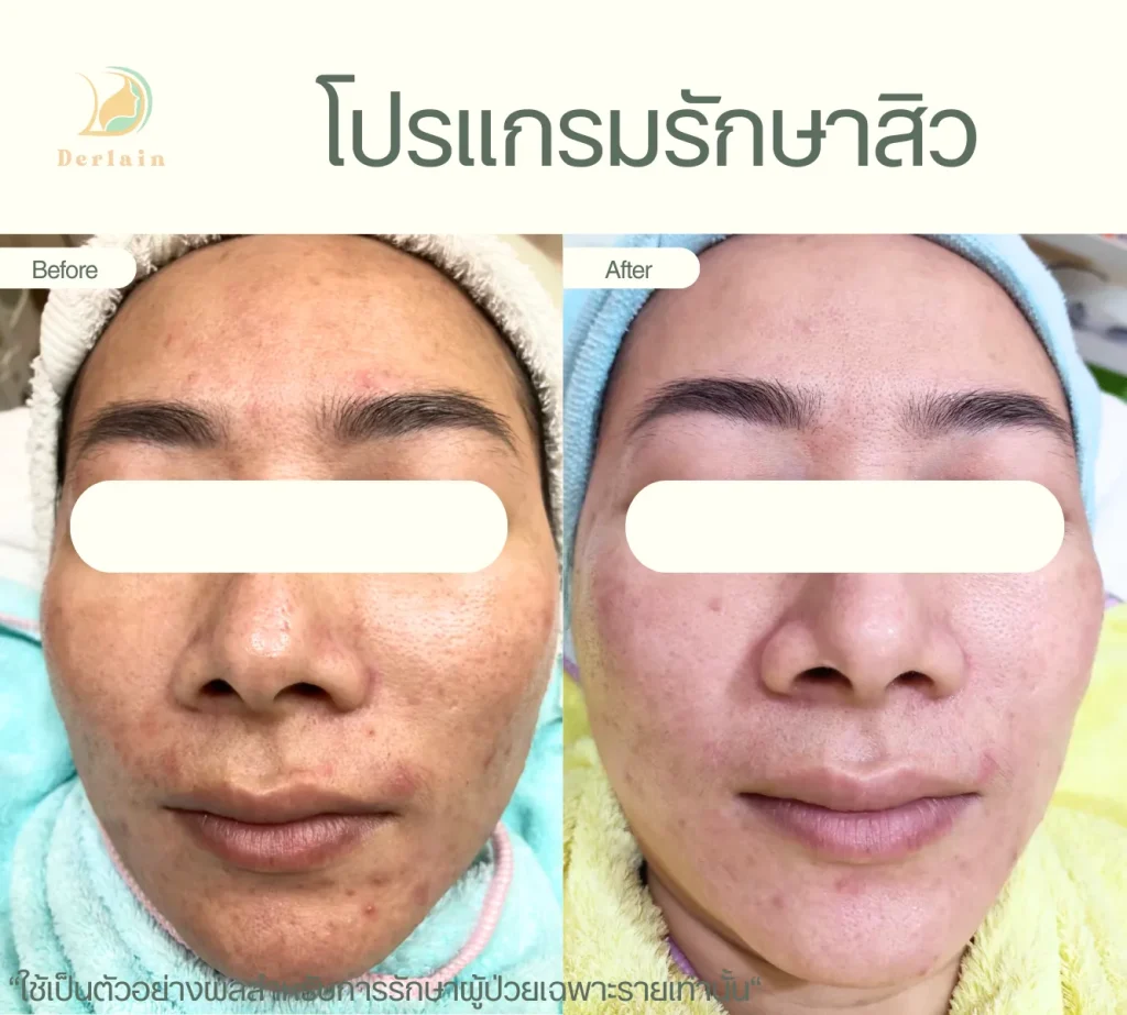 รีวิวโปรแกรมรักษาสิว 18 - เดอร์เลนคลินิก