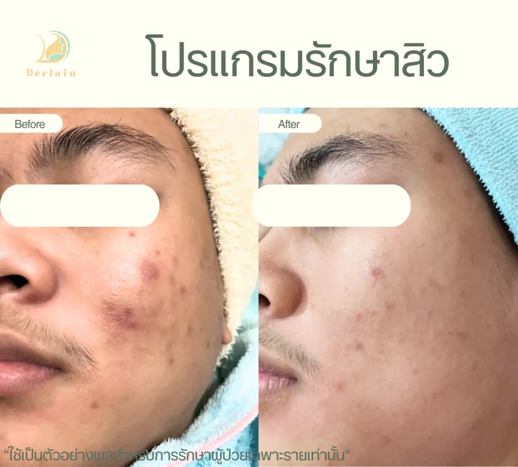 รีวิวโปรแกรมรักษาสิว 17 - เดอร์เลนคลินิก
