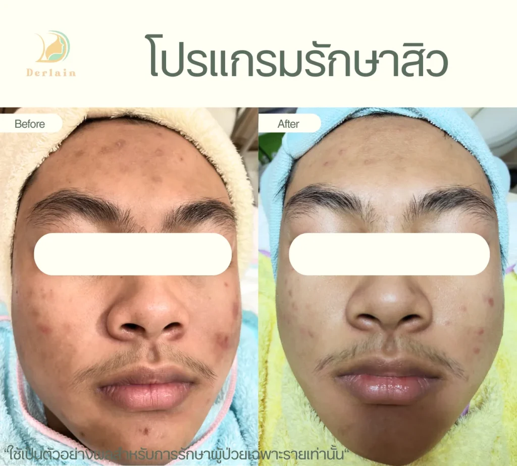 รีวิวโปรแกรมรักษาสิว 16 - เดอร์เลนคลินิก