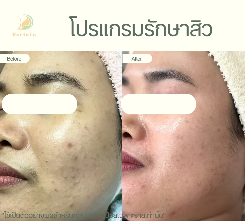 รีวิวโปรแกรมรักษาสิว 15 - เดอร์เลนคลินิก