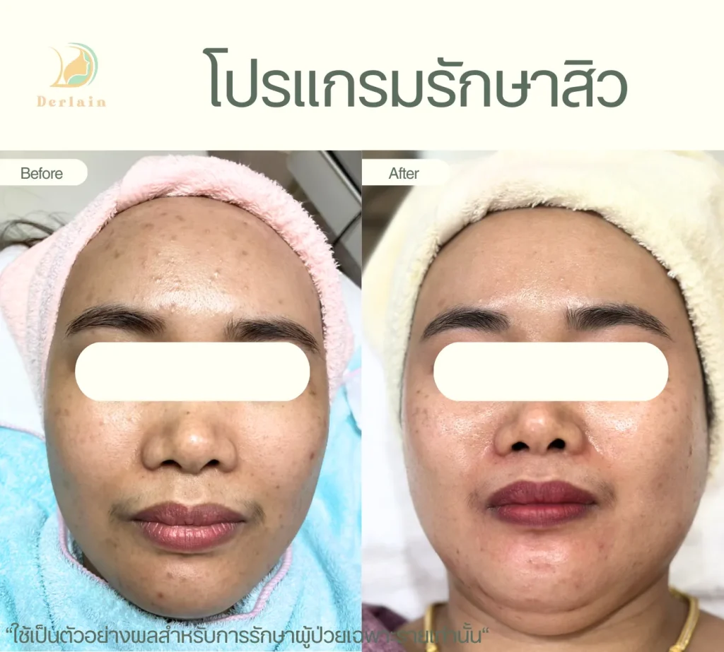 รีวิวโปรแกรมรักษาสิว 14 - เดอร์เลนคลินิก