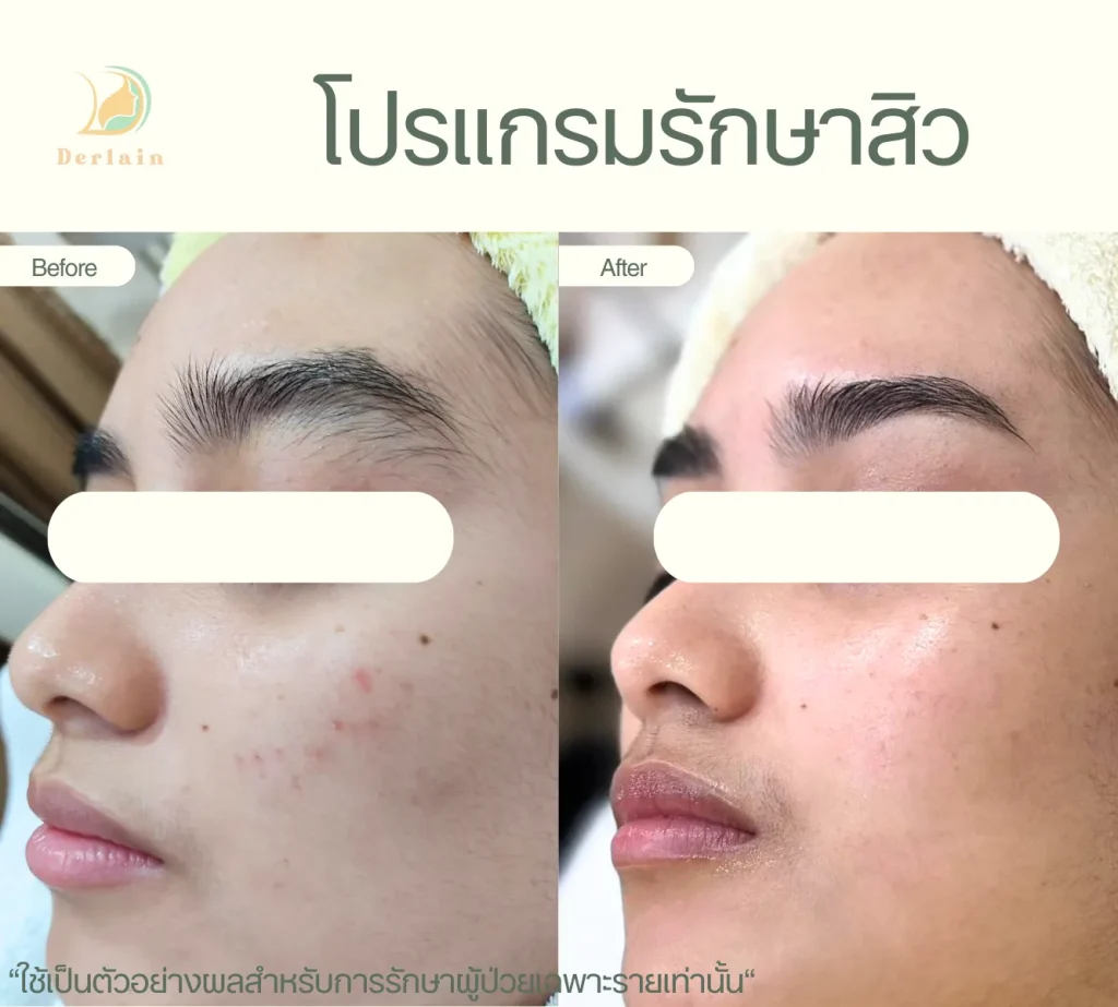 รีวิวโปรแกรมรักษาสิว 13 - เดอร์เลนคลินิก