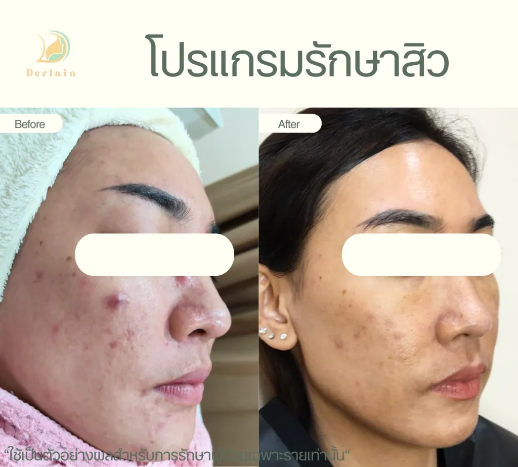 รีวิวโปรแกรมรักษาสิว 12 - เดอร์เลนคลินิก