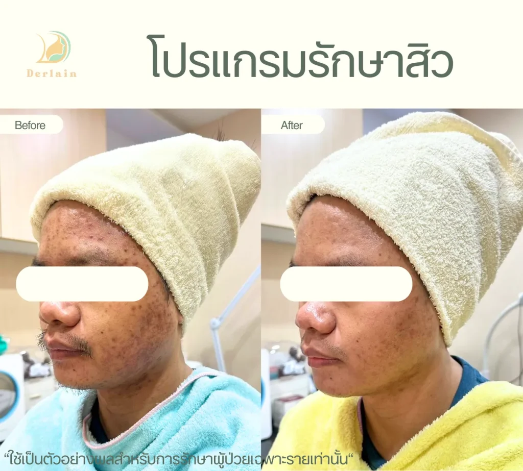 รีวิวโปรแกรมรักษาสิว 29 - เดอร์เลนคลินิก