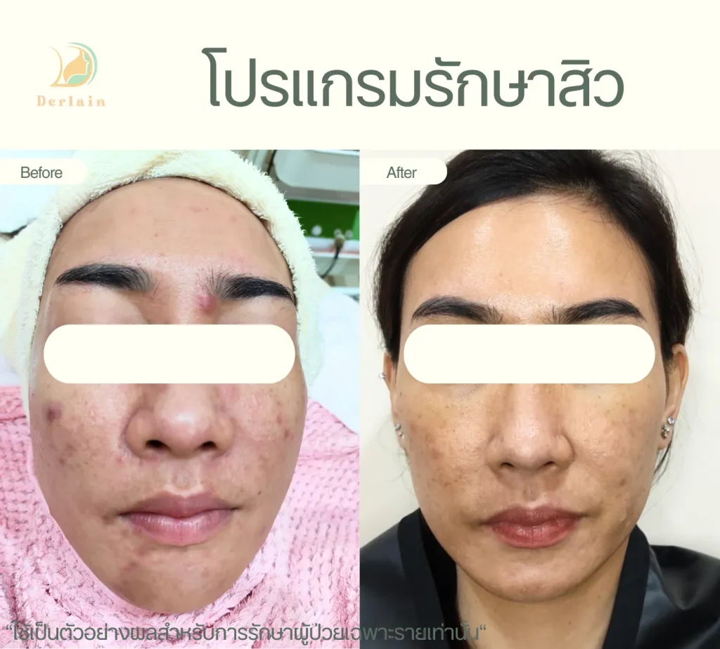 รีวิวโปรแกรมรักษาสิว 11 - เดอร์เลนคลินิก