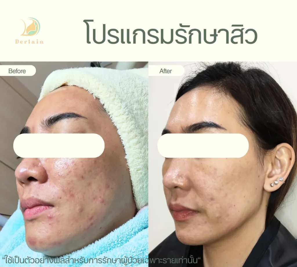 รีวิวโปรแกรมรักษาสิว 10 - เดอร์เลนคลินิก