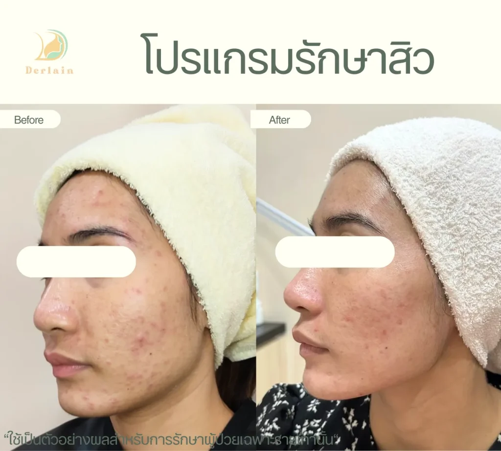 รีวิวโปรแกรมรักษาสิว 9 - เดอร์เลนคลินิก