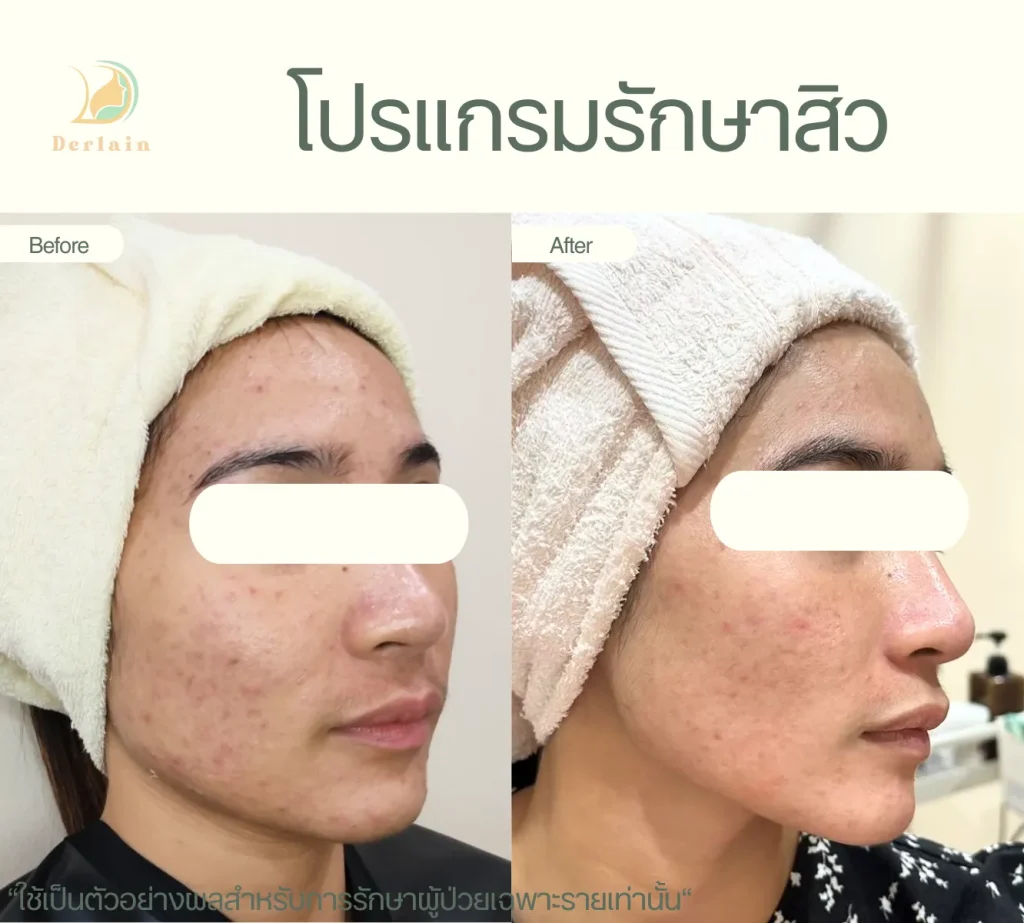 รีวิวโปรแกรมรักษาสิว 8 - เดอร์เลนคลินิก