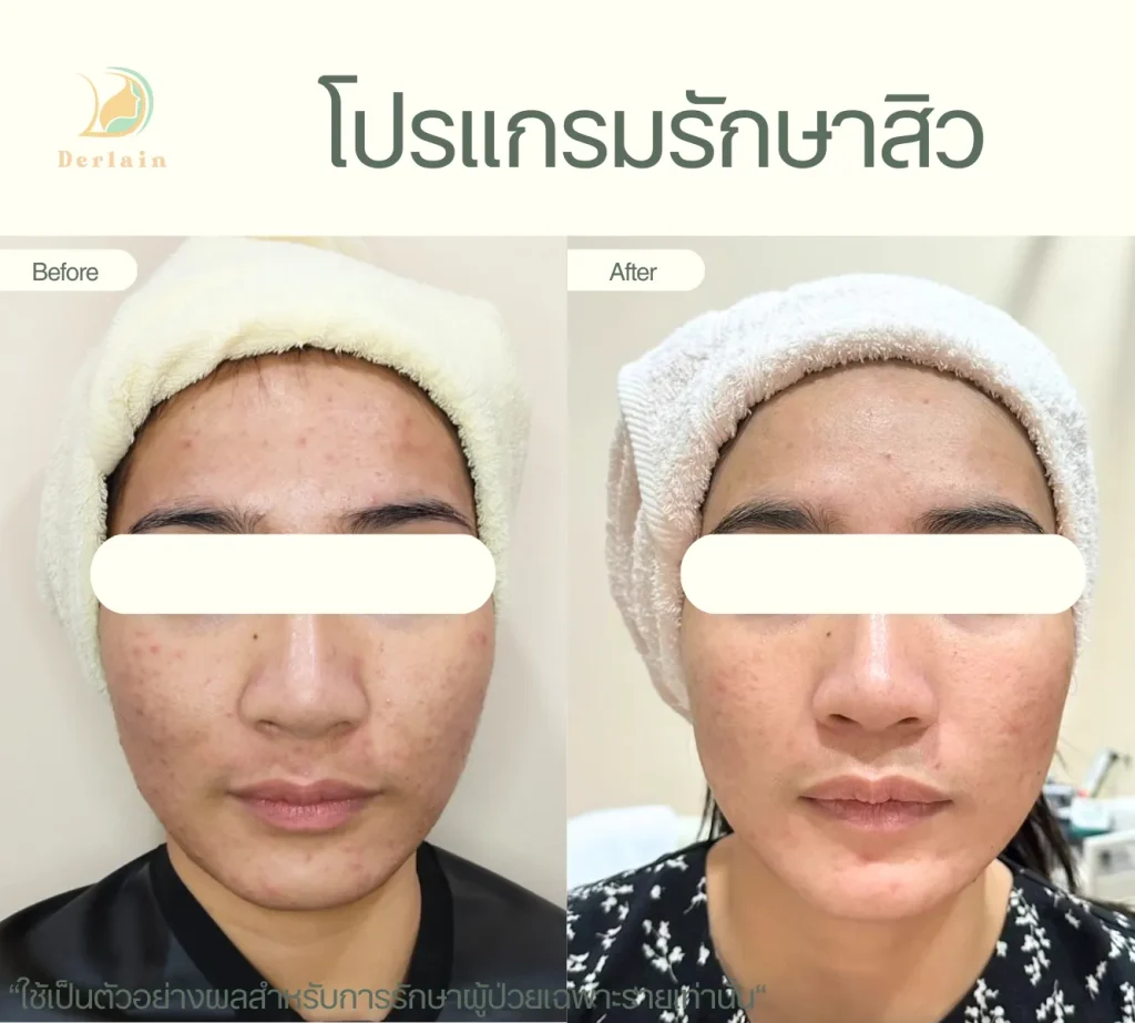 รีวิวโปรแกรมรักษาสิว 7 - เดอร์เลนคลินิก