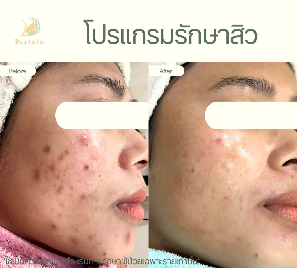 รีวิวโปรแกรมรักษาสิว 6 - เดอร์เลนคลินิก