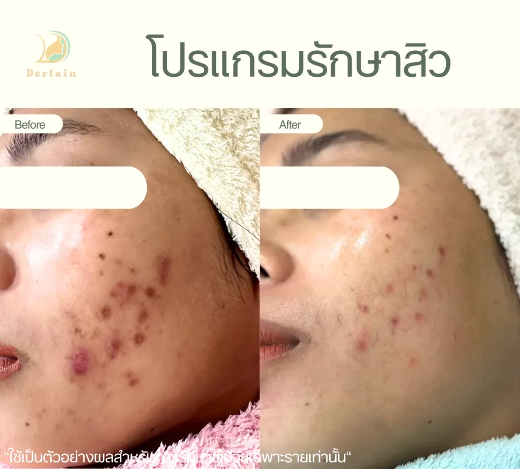 รีวิวโปรแกรมรักษาสิว 5 - เดอร์เลนคลินิก