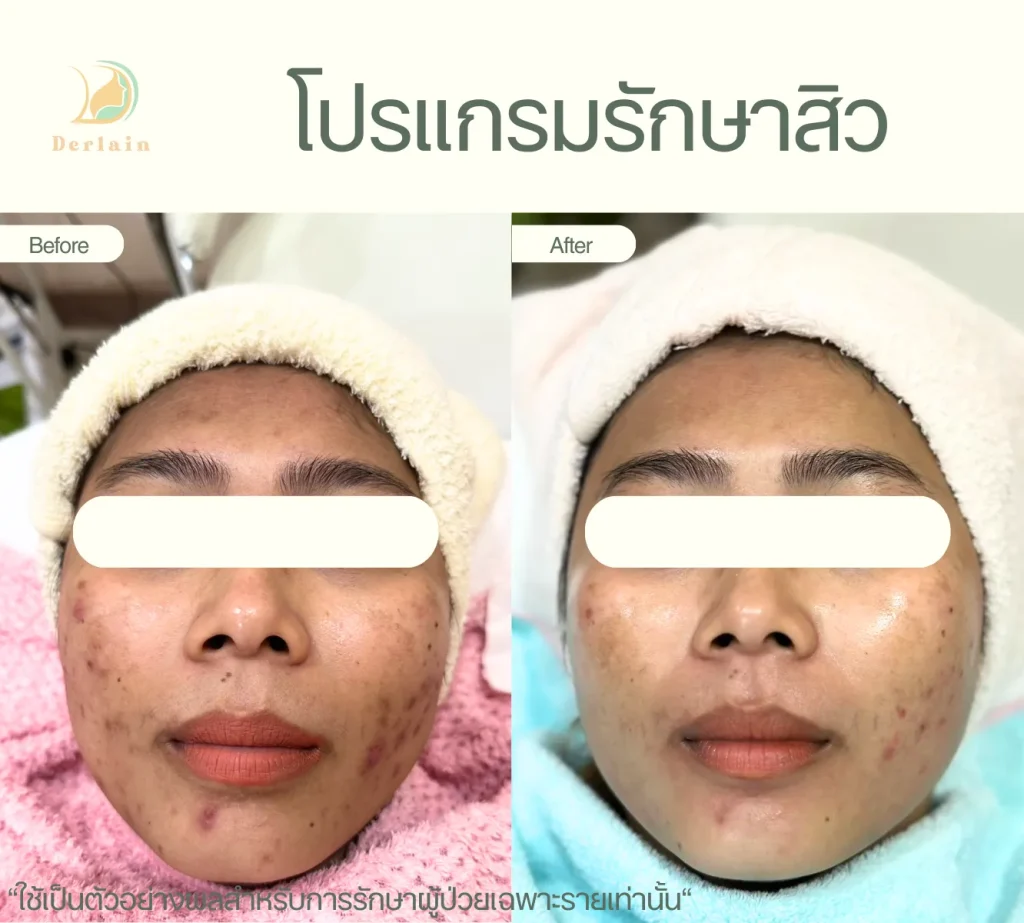 รีวิวโปรแกรมรักษาสิว 4 - เดอร์เลนคลินิก