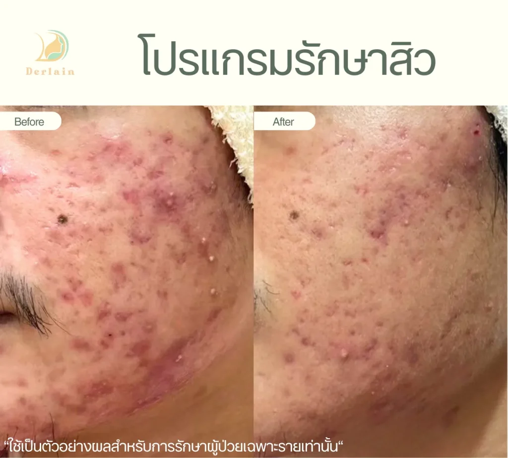 รีวิวโปรแกรมรักษาสิว 3 - เดอร์เลนคลินิก