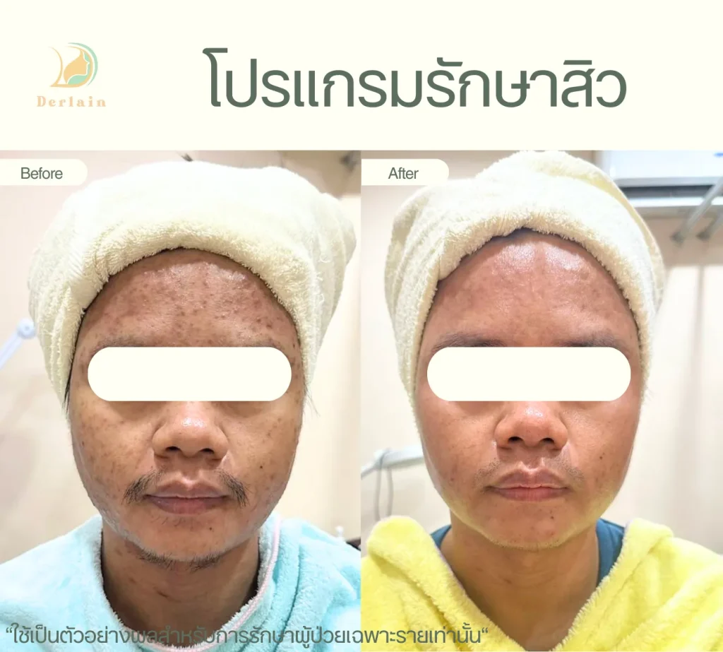 รีวิวโปรแกรมรักษาสิว 28 - เดอร์เลนคลินิก