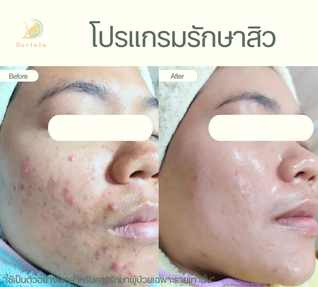 รีวิวโปรแกรมรักษาสิว 27 - เดอร์เลนคลินิก