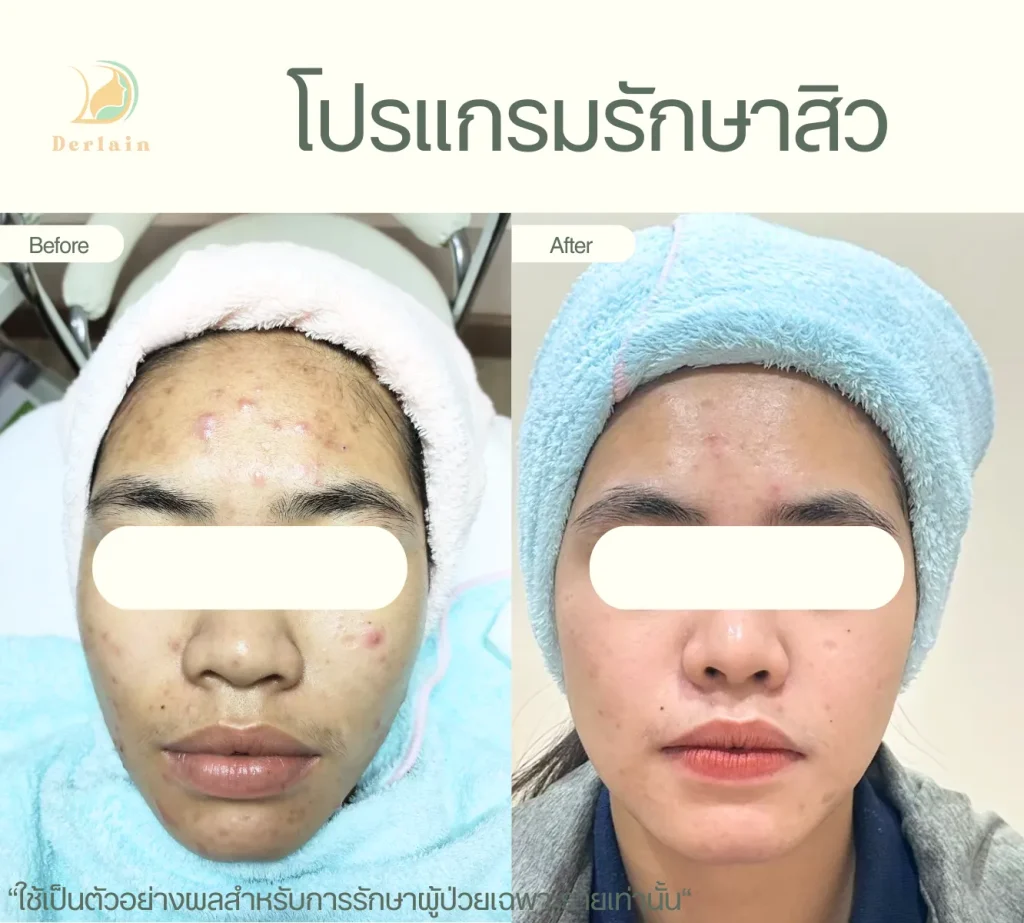 รีวิวโปรแกรมรักษาสิว 26 - เดอร์เลนคลินิก