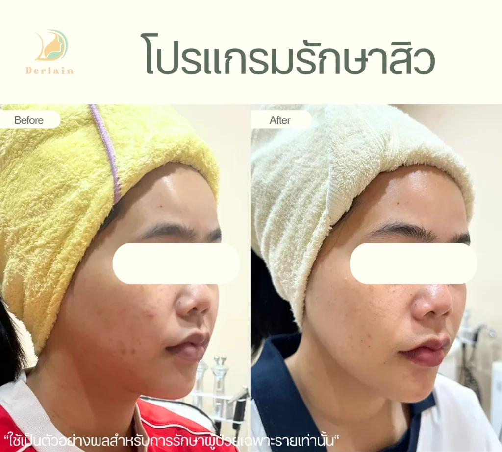 รีวิวโปรแกรมรักษาสิว 25 - เดอร์เลนคลินิก