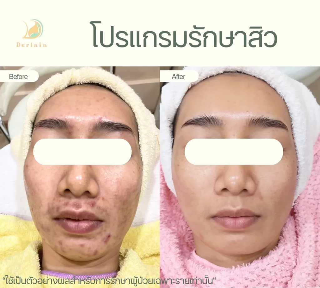 รีวิวโปรแกรมรักษาสิว 24 - เดอร์เลนคลินิก