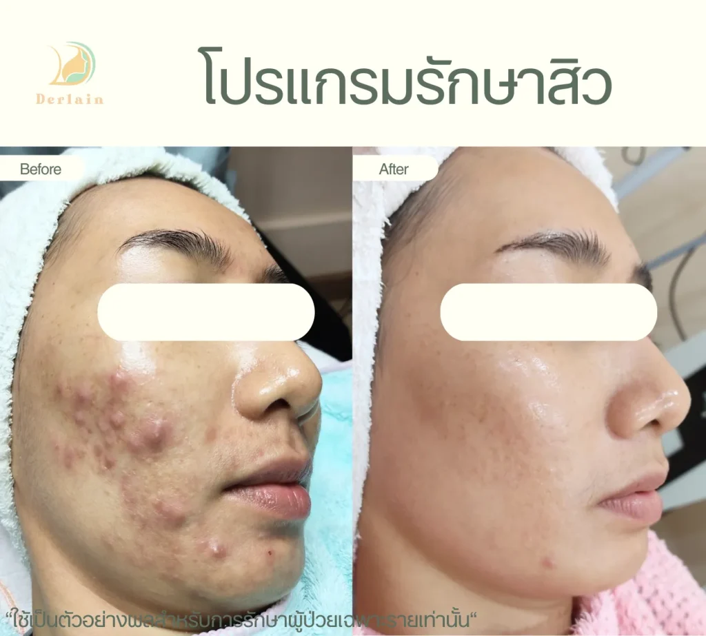 รีวิวโปรแกรมรักษาสิว 23 - เดอร์เลนคลินิก