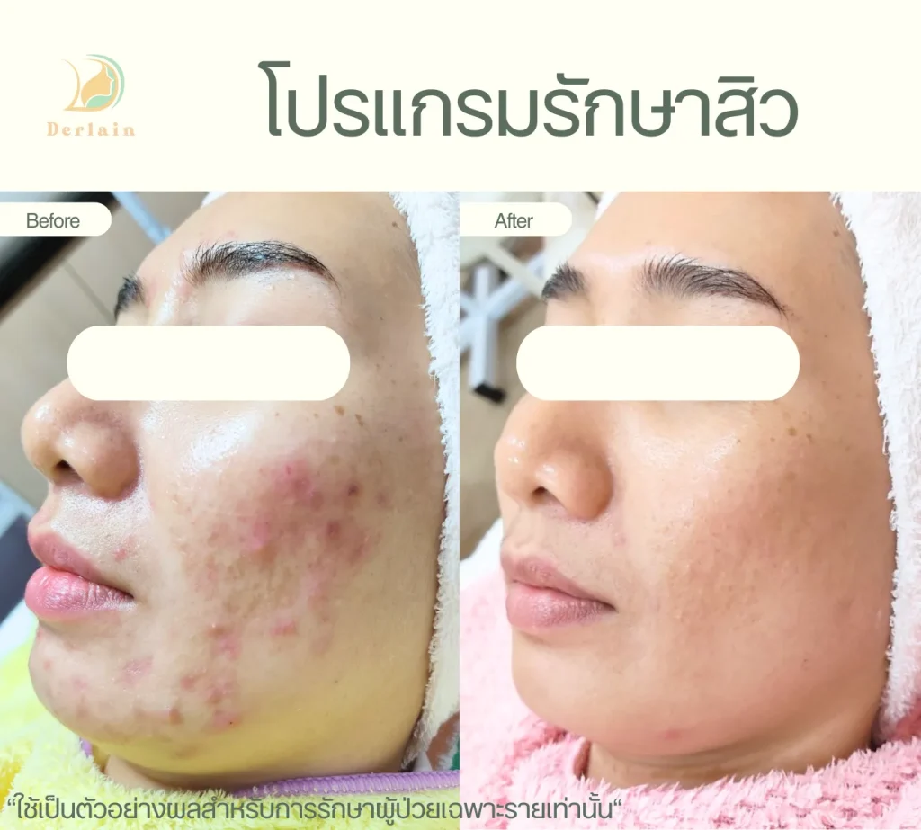 รีวิวโปรแกรมรักษาสิว 22 - เดอร์เลนคลินิก