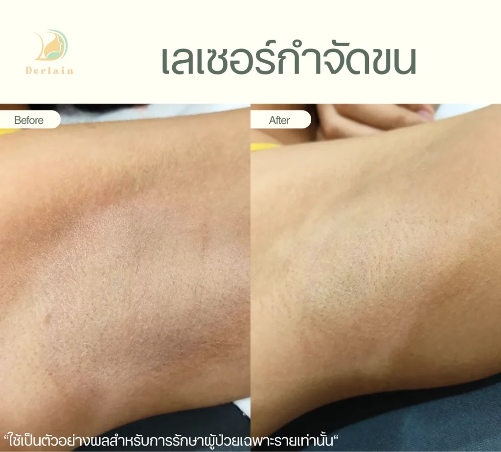 รีวิวเลเซอร์ขน 1 - เดอร์เลนคลินิก