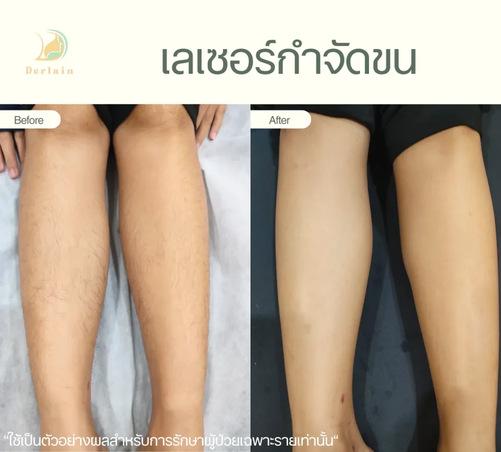 รีวิวเลเซอร์ขน 2 - เดอร์เลนคลินิก