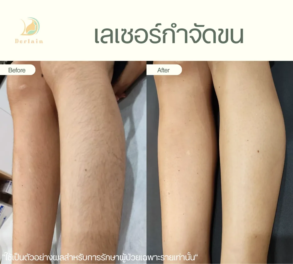 รีวิวเลเซอร์ขน 3 - เดอร์เลนคลินิก