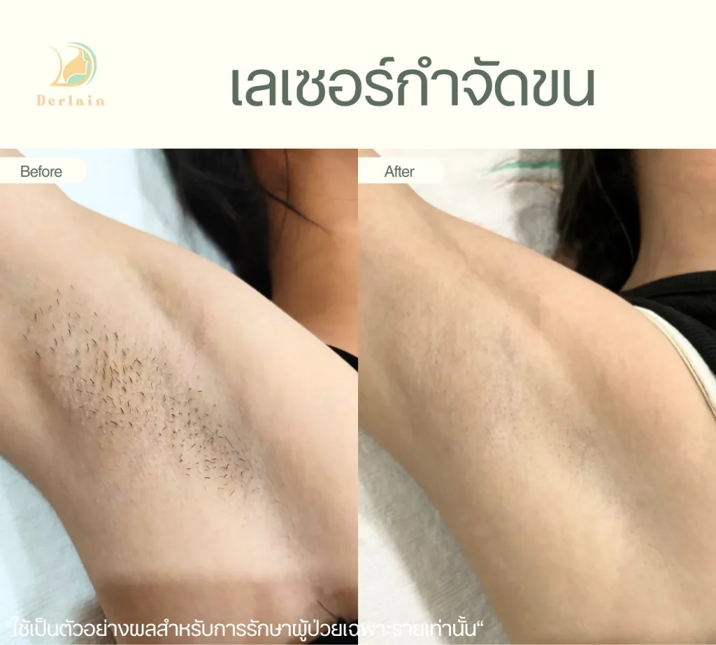 รีวิวเลเซอร์ขน 4 - เดอร์เลนคลินิก