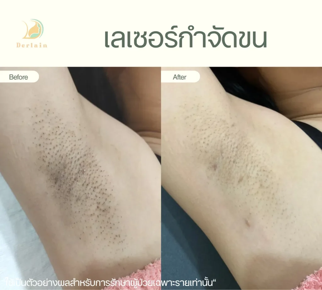 รีวิวเลเซอร์ขน 5 - เดอร์เลนคลินิก