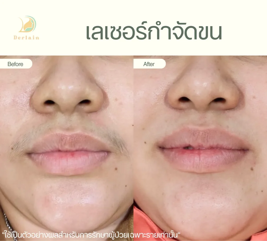 รีวิวเลเซอร์ขน 5 - เดอร์เลนคลินิก